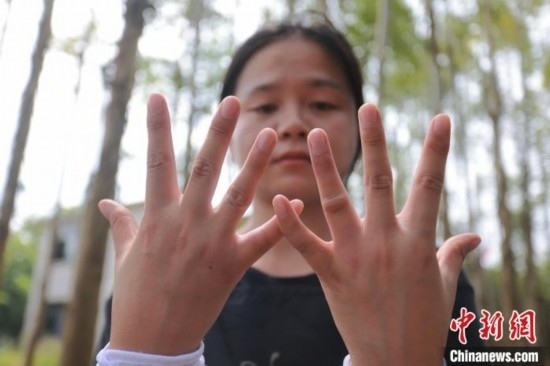 吳素英展示被蜜蜂蜇過的雙手。湯曉逵 攝