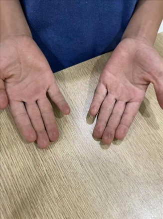 9歲小學(xué)生長期拍煙卡，手部粗糙長繭。受訪者供圖